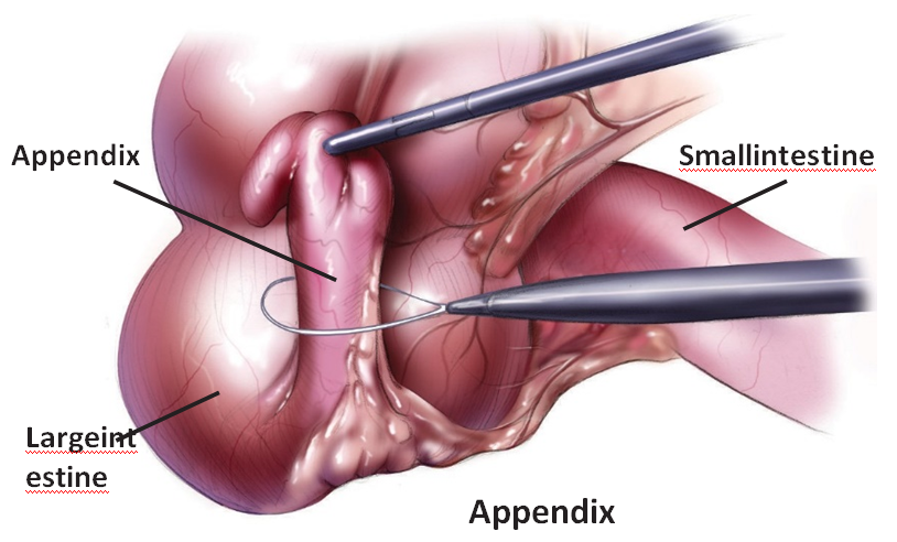 Appendix Removal Hospital in Ahmedabad