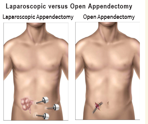 laparoscopic open appendectomy in Ahmedabad
