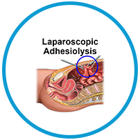 laparoscopy adhesiolysis