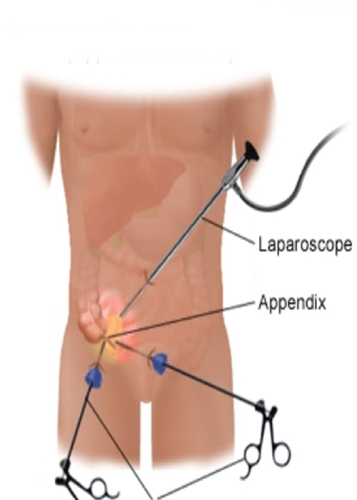 Appendix Hospital In Ahmedabad