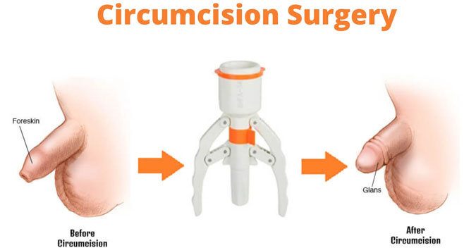 Circumcision Surgery In Ahmedabad, Gujarat, Satellite